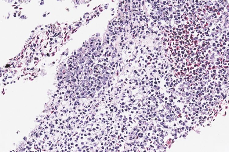 Imagen 1: Corte histológico. Tinción HE. Inflamación en el ojo con bacterias, de un caso con Pseudomonas spp. demostrada. Créditos: PHARMAQ Analytiq.
